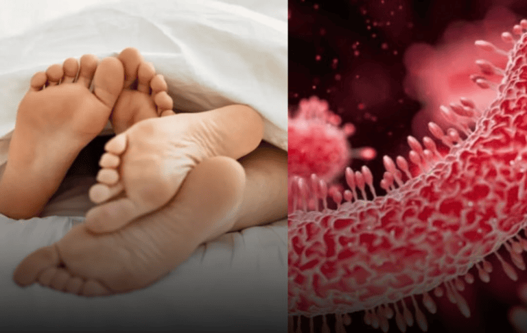 La shigellose, une infection bactérienne qui provoque la dysenterie, se propage de plus en plus par contact sexuel, tandis que