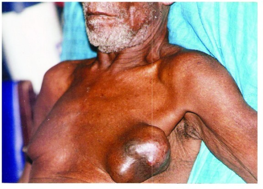 Le cancer du sein touche aussi les hommes, voici comment le détecter Le cancer du sein touche aussi les hommes